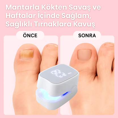 PureNail™ – Lazerli Tırnak Terapi Cihazı